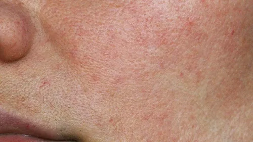 Best Skincare for Rosacea: Ingredients That Soothe and Protect