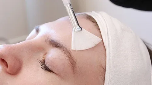 Best Treatments for Melasma: Laser, Chemical Peels, and Microneedling