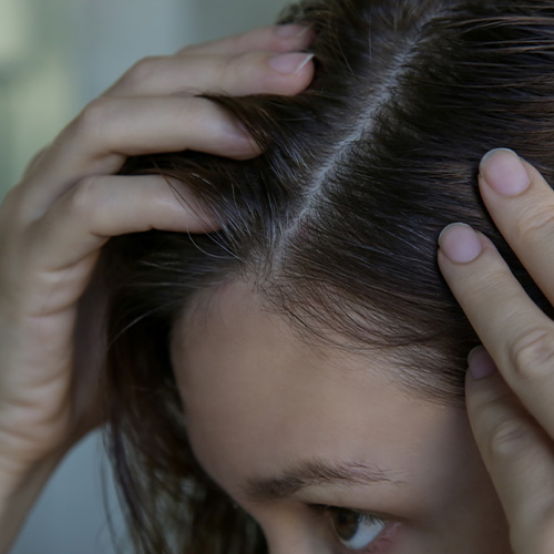 skin-clinic-What-Causes-Hair-Loss