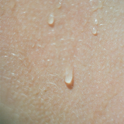 botox-hyperhidrosis-
