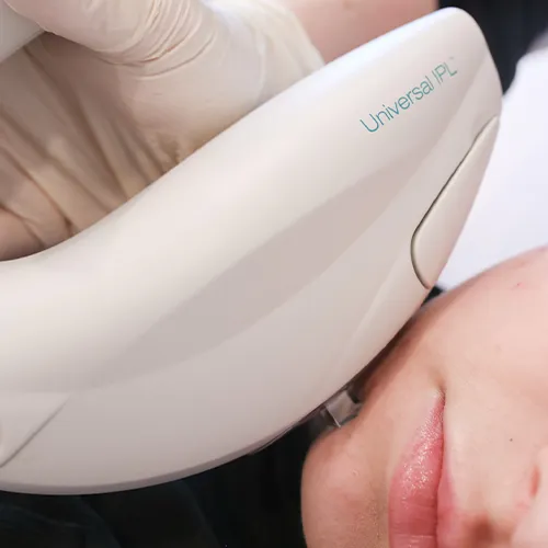 IPL Treatment at SKIN Clinics