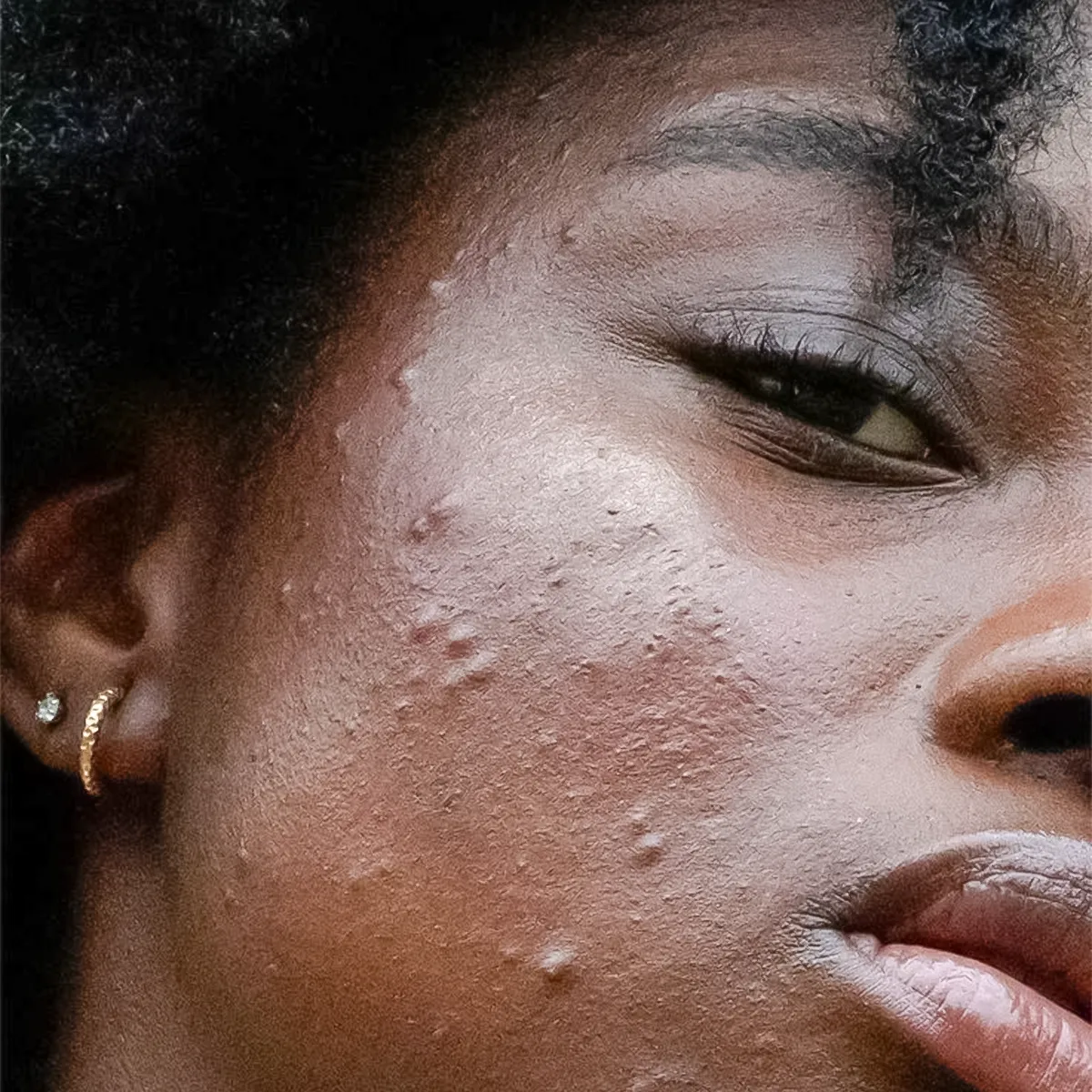 Acne Scar Types and Effective Treatments