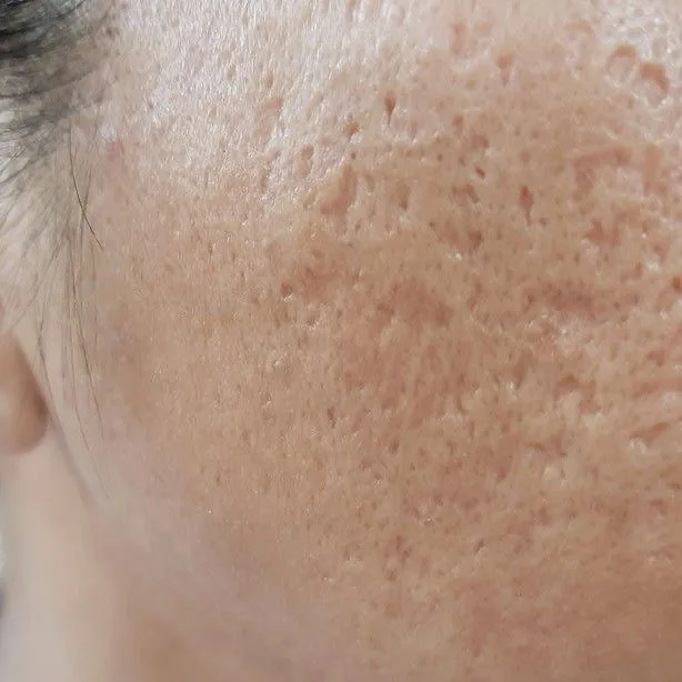 Acne Scars — in clinic