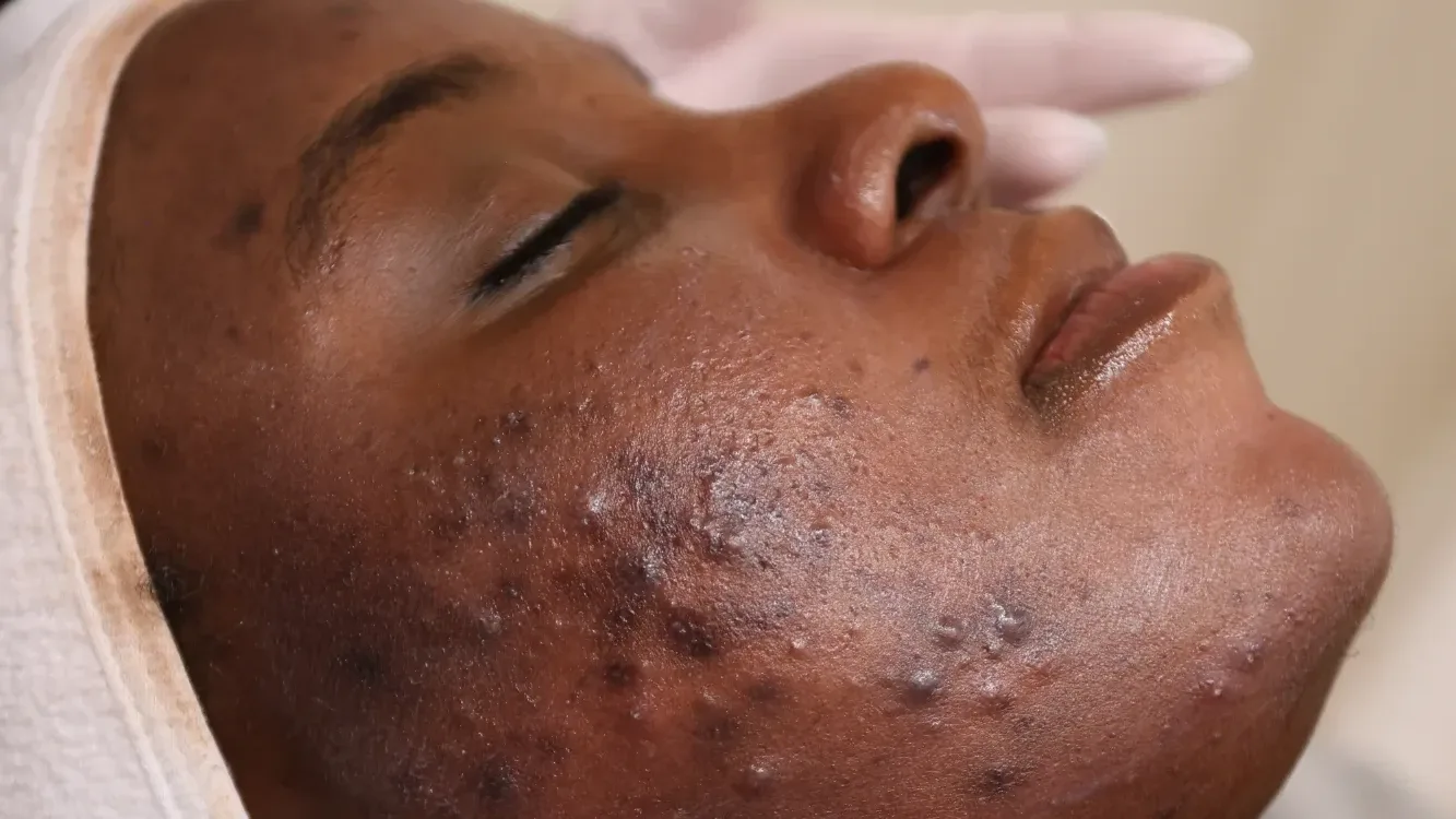 Hormonal Acne — in clinic
