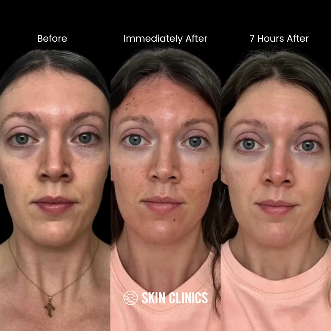 PRP Facial Treatment