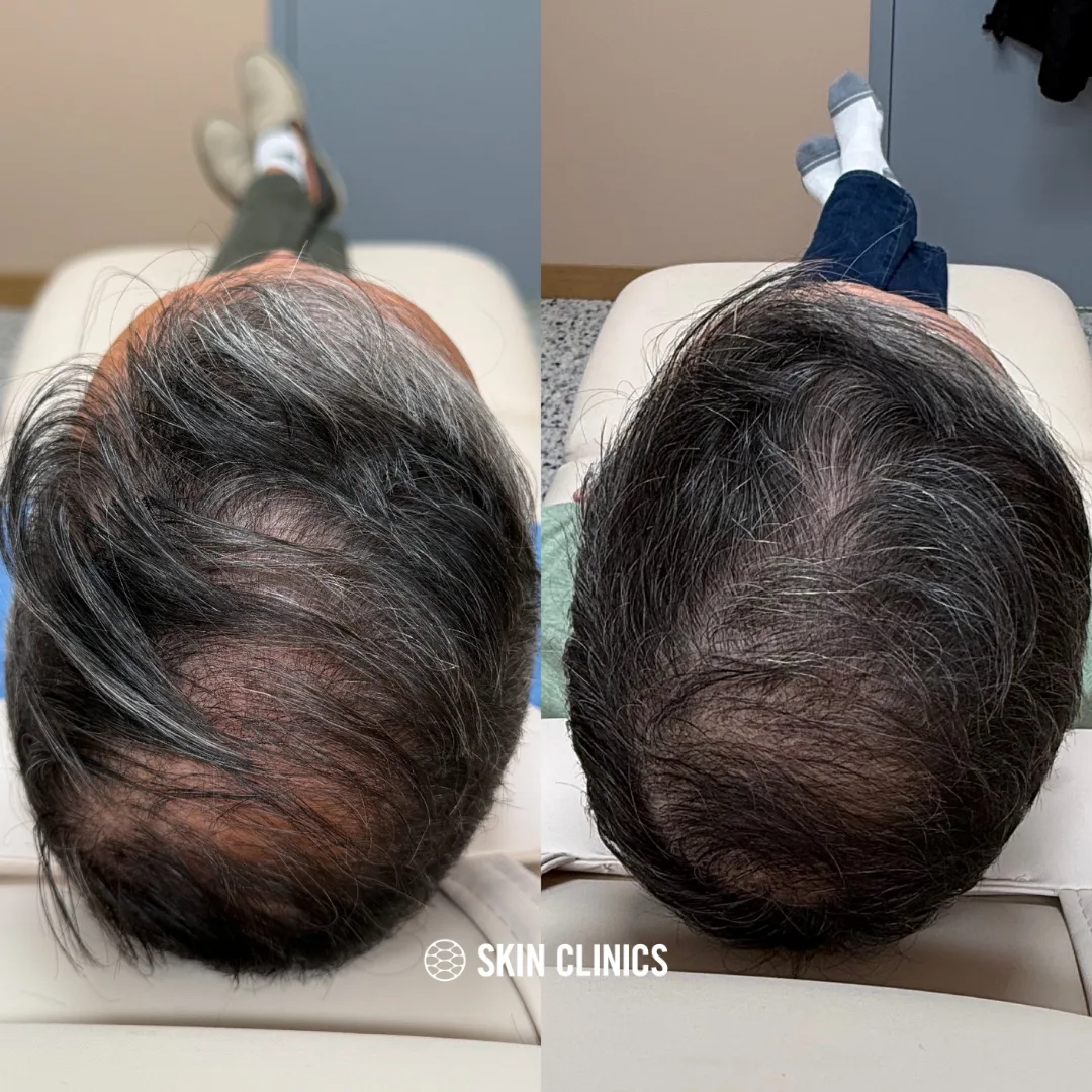 PRP Hair Treatment