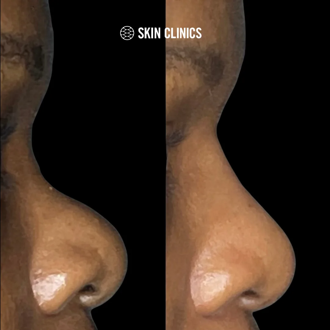 Liquid Rhinoplasty