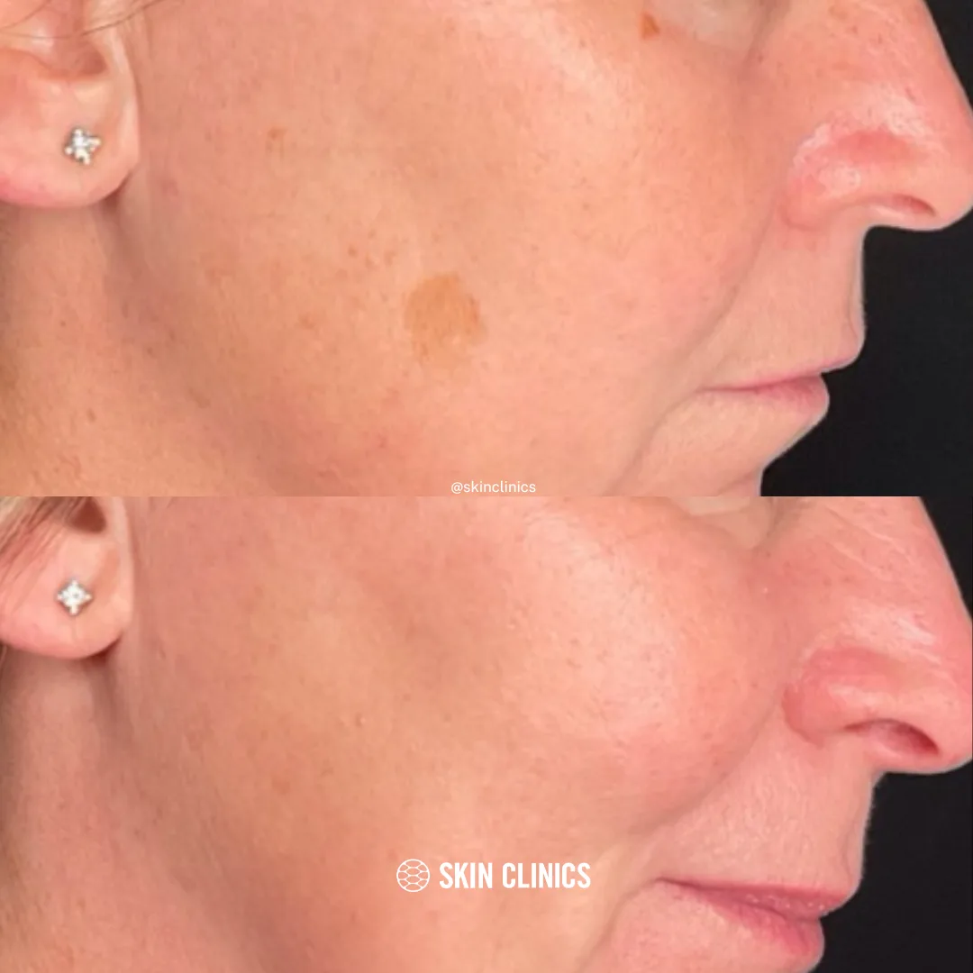 IPL Spot Treatment