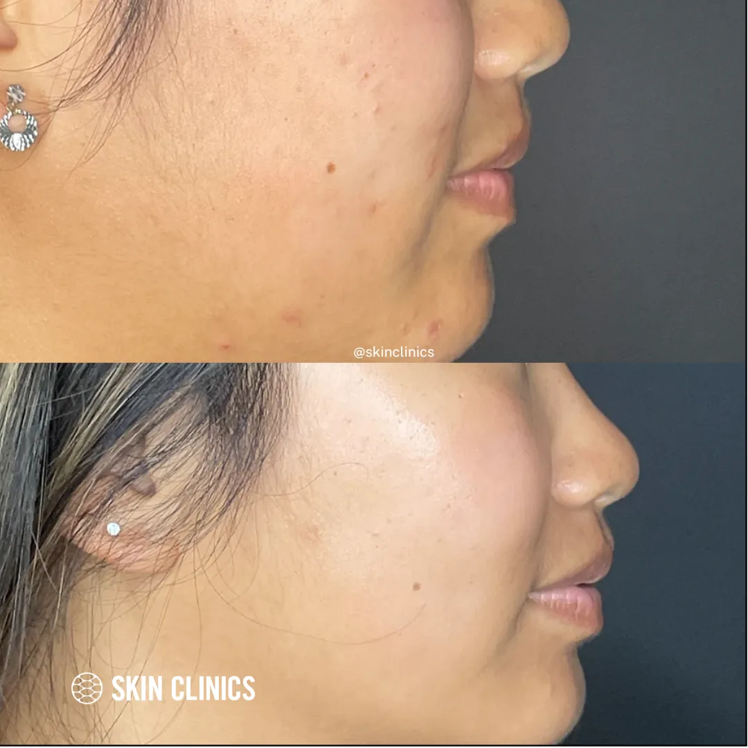 OxyGeneo Facial
