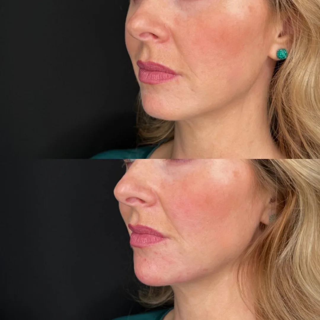 Chin filler