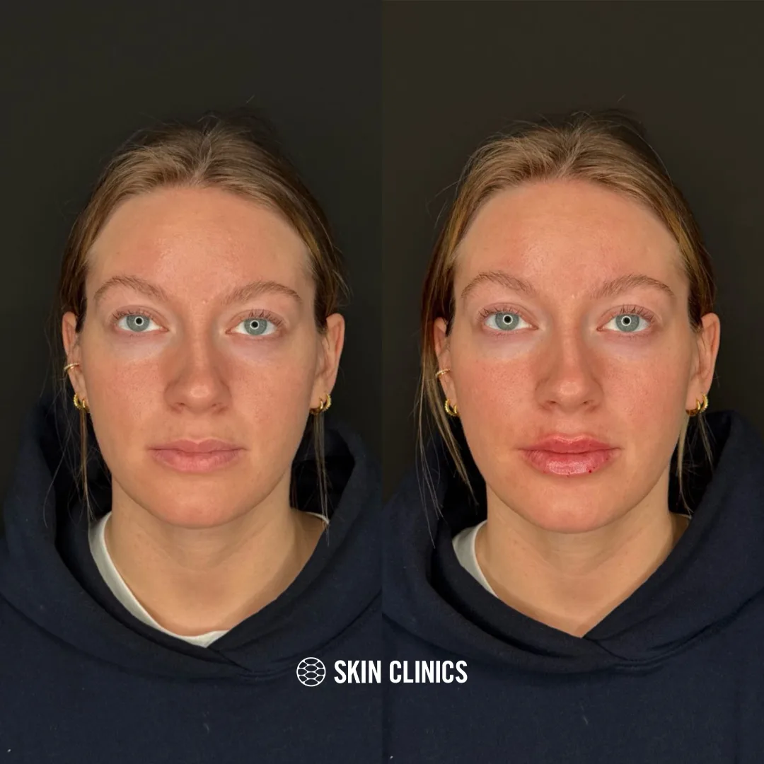 Lip Filler