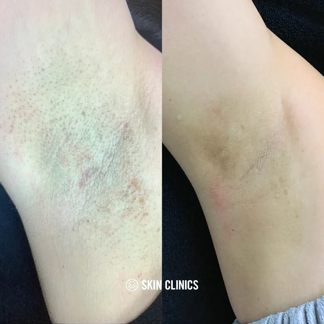 Laser hair removal on the underarms