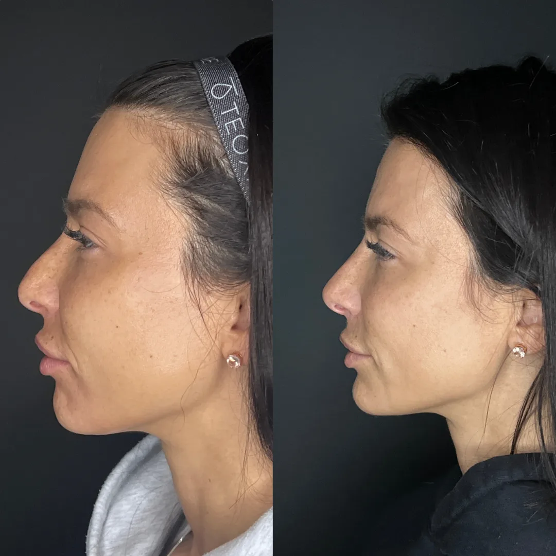 Facial balancing using dermal filler
