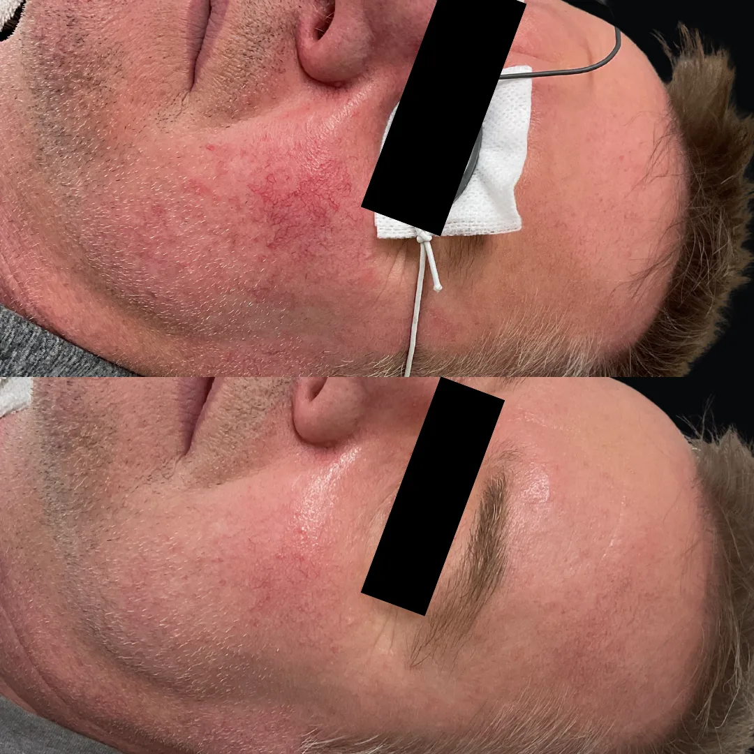 Laser Vein Treatment on the Face