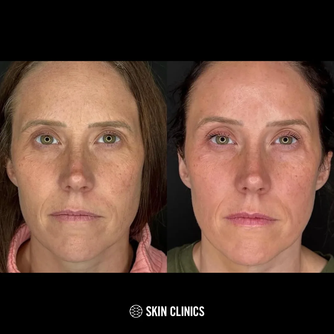 Full face Neuromodulator treatment and use of medical grade skincare
