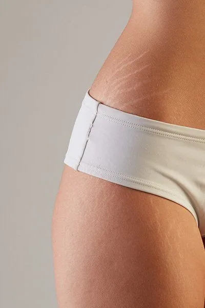 Stretch Mark Reduction — treatment