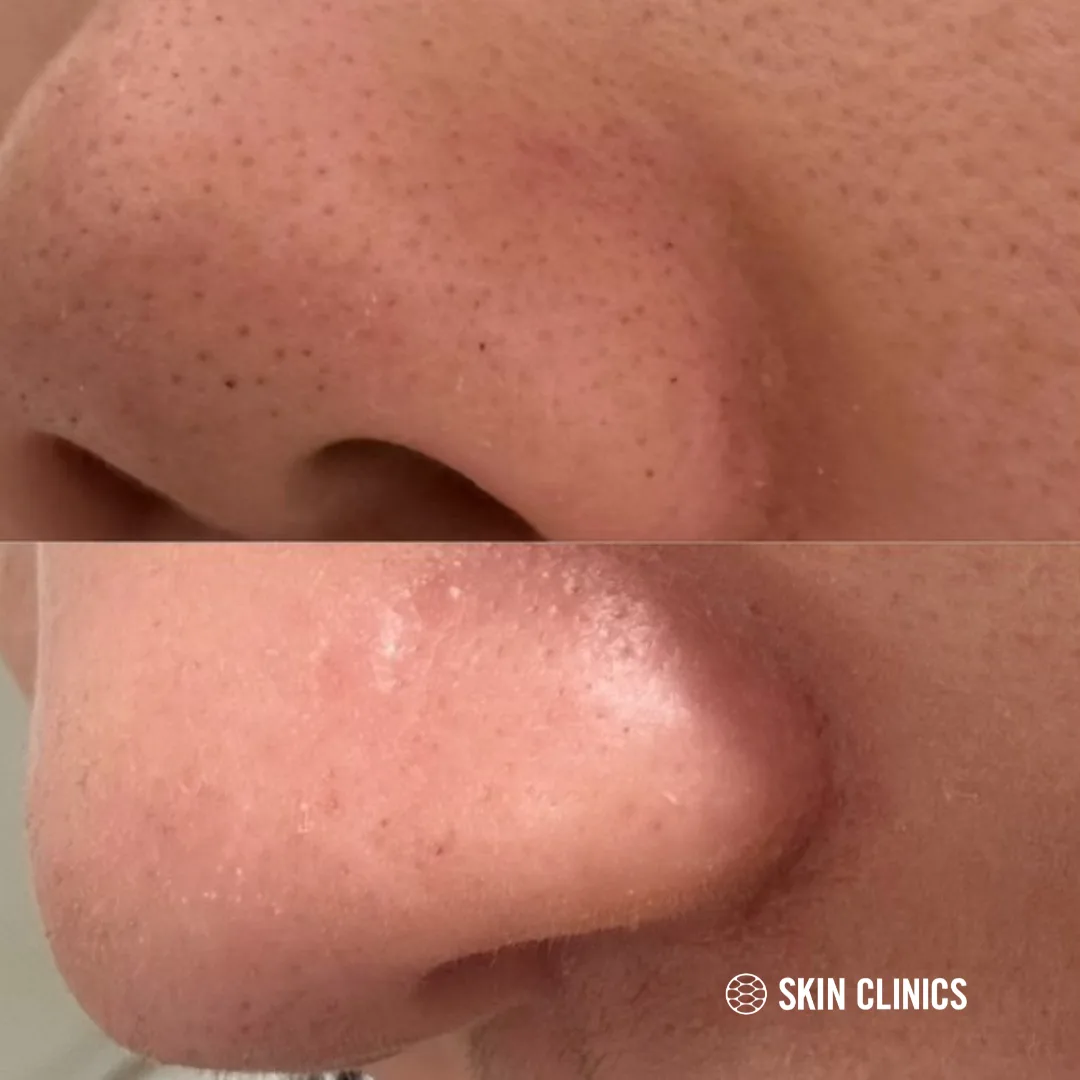 Hydrafacial