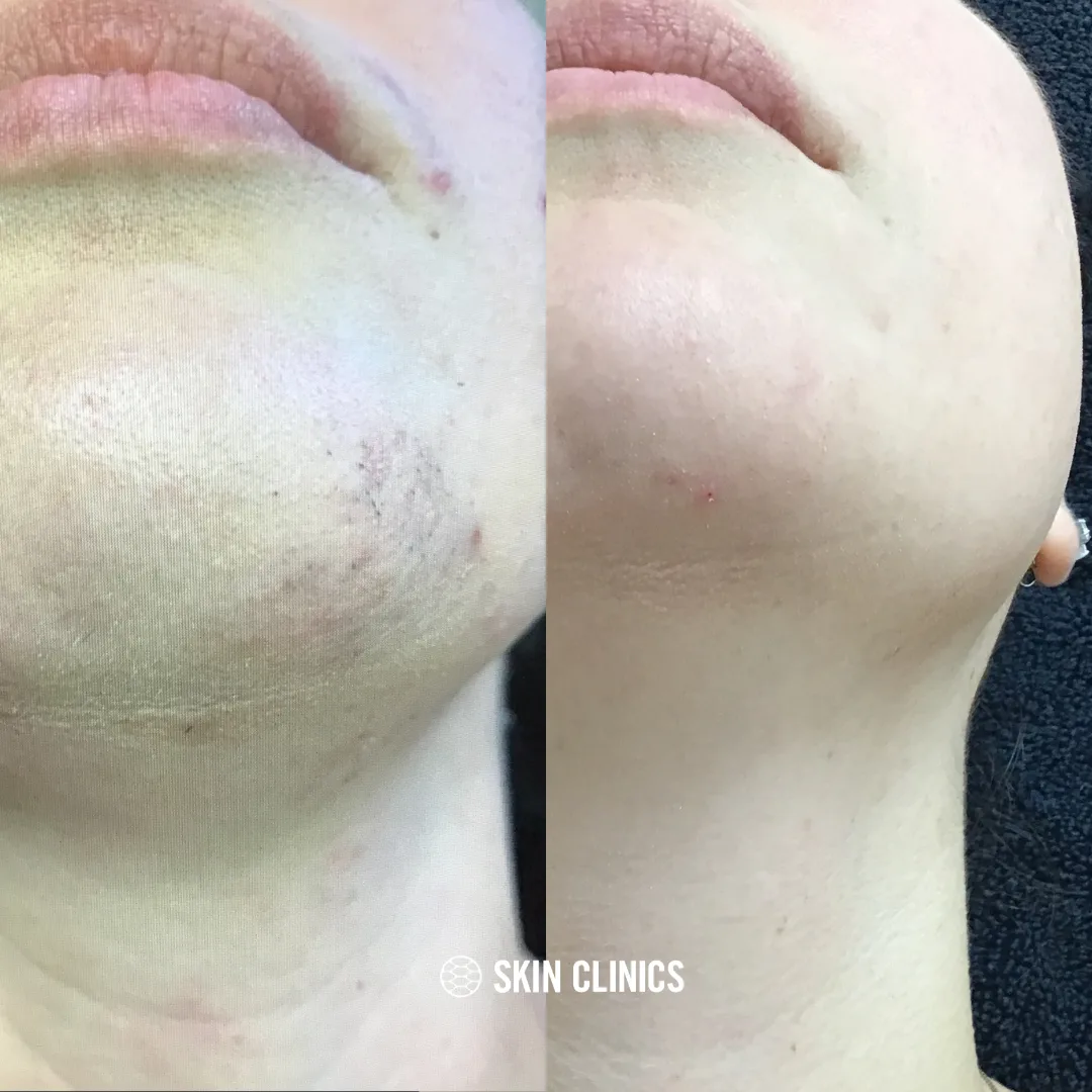 Laser hair removal on the chin