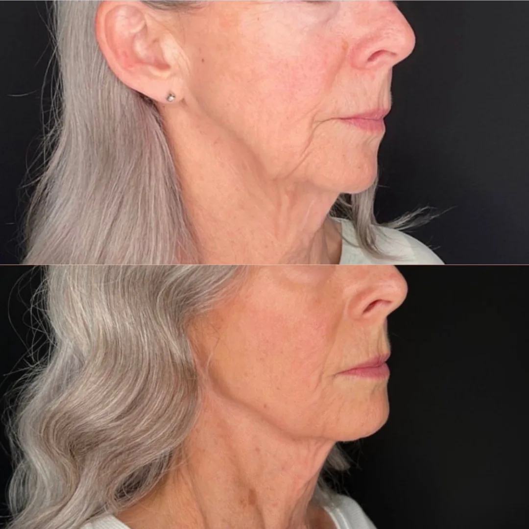 Radiesse Treatment