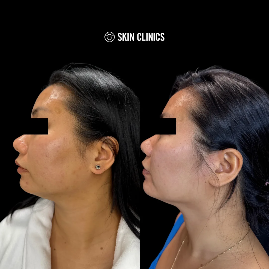 Laser Acne Scar Treatment