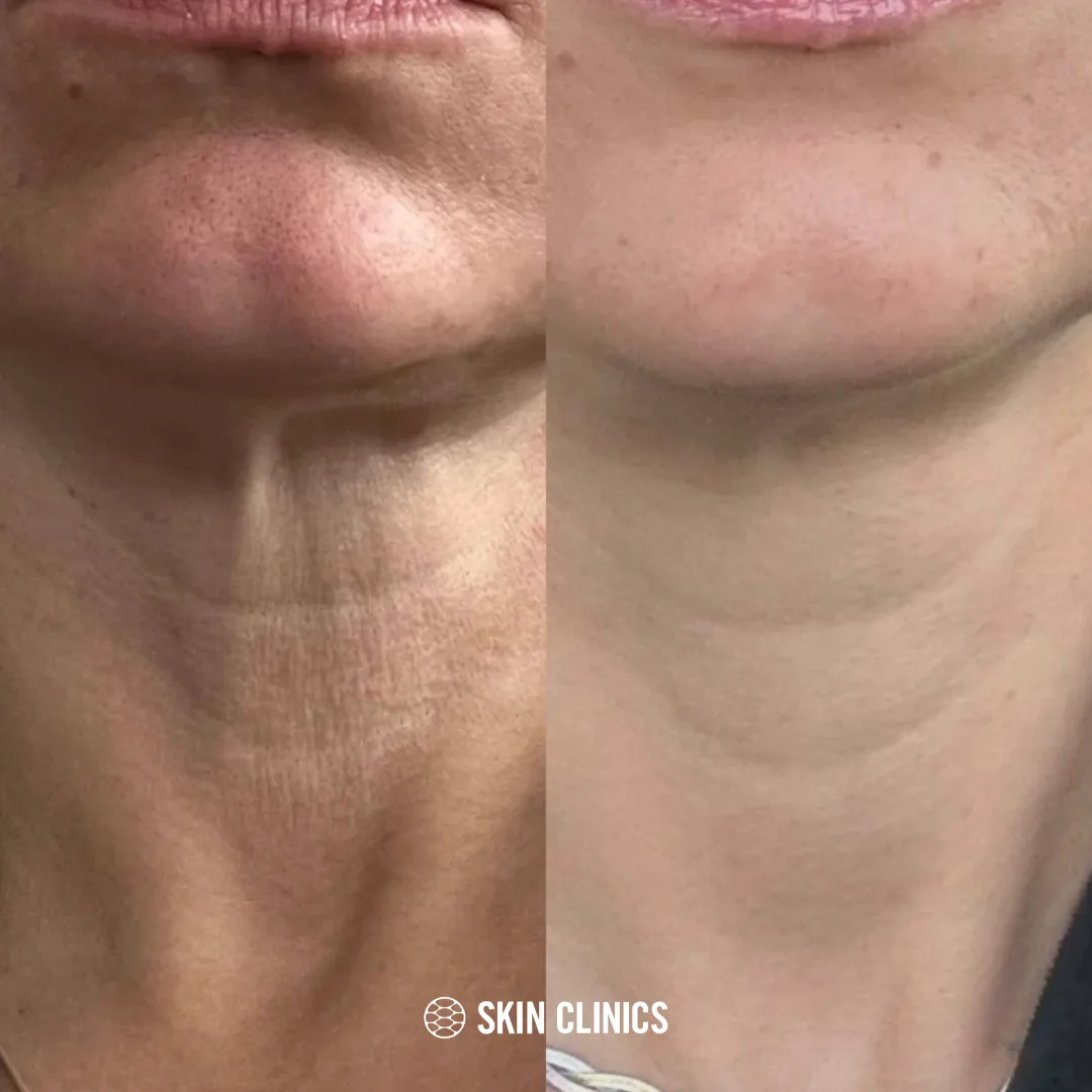 Microneedling Neck Treatment