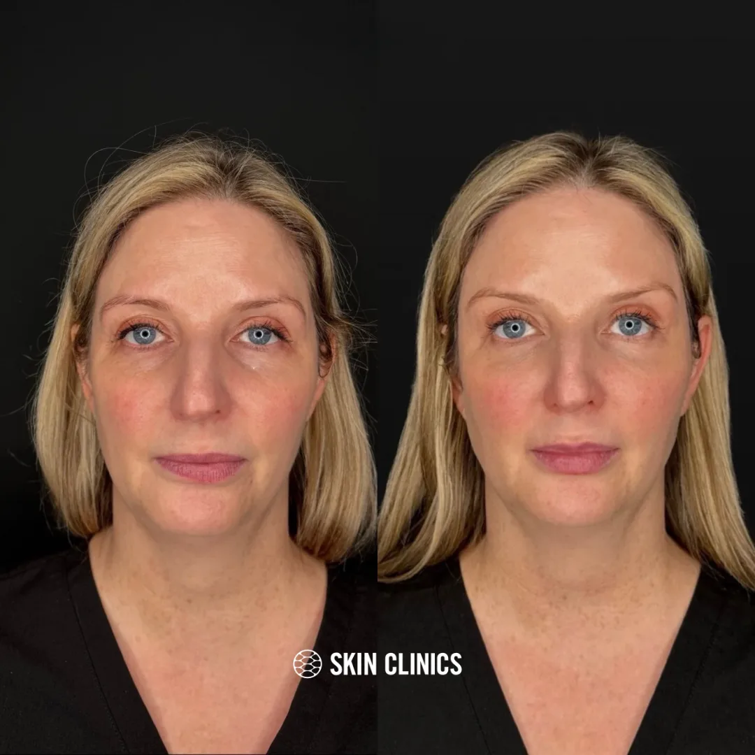 Full facial rejuvenation using dermal fillers