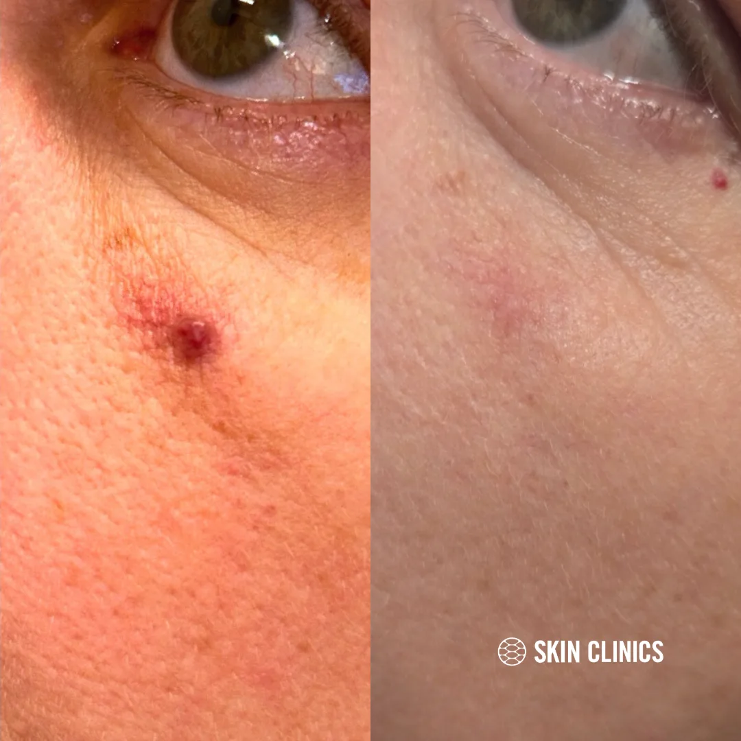 Benigns lesion removal on the face