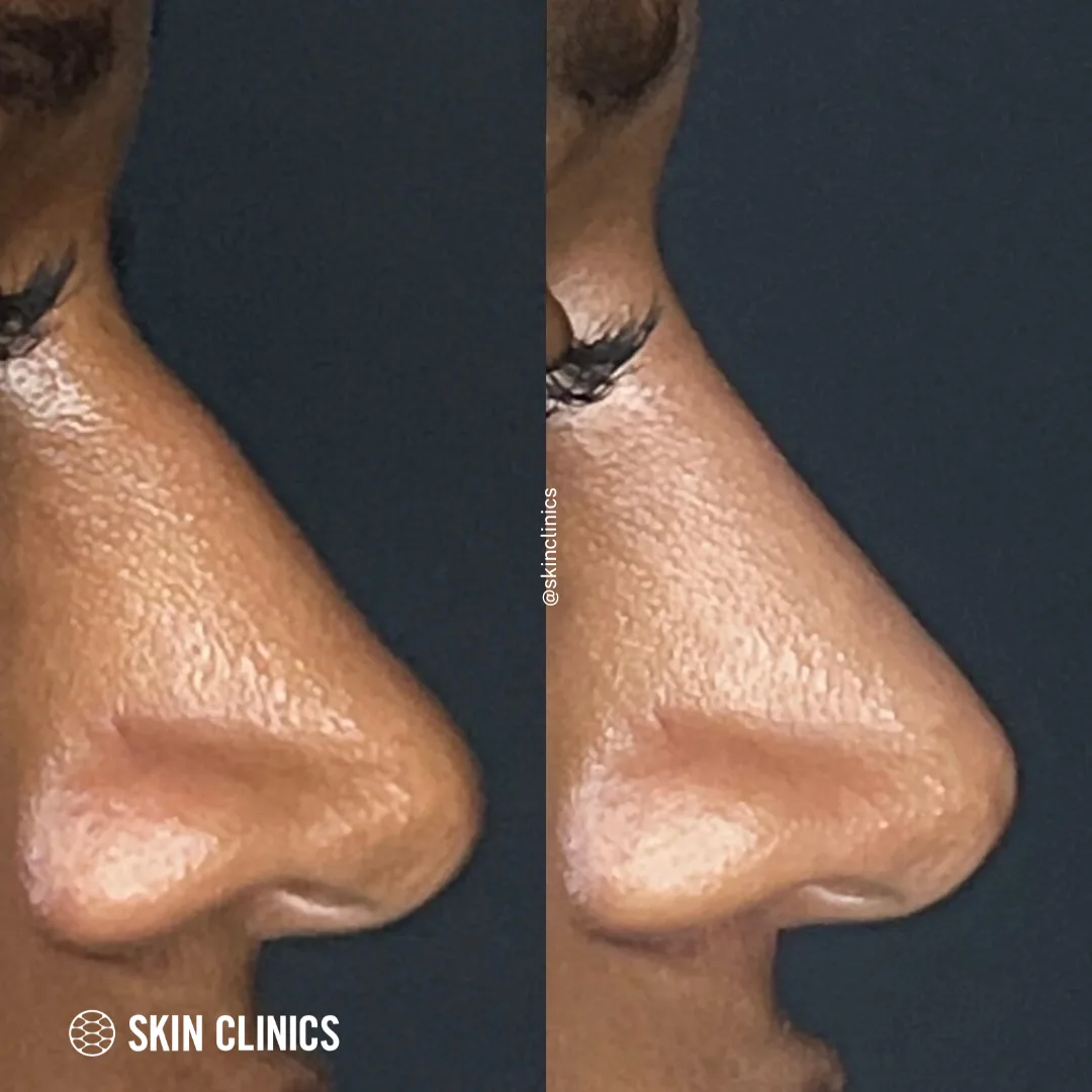 Liquid Rhinoplasty