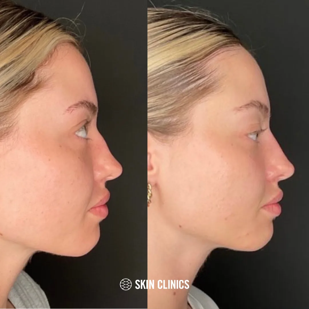 Liquid Rhinoplasty