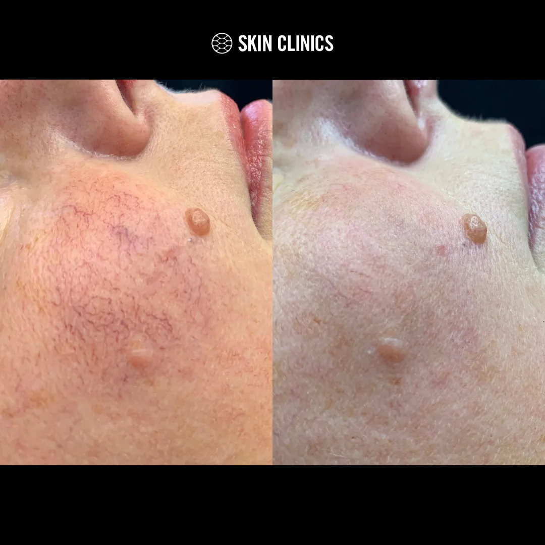 Laser vein treatment