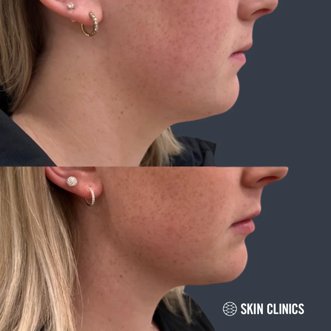 Deoxycholic Acid and Filler Treatment
