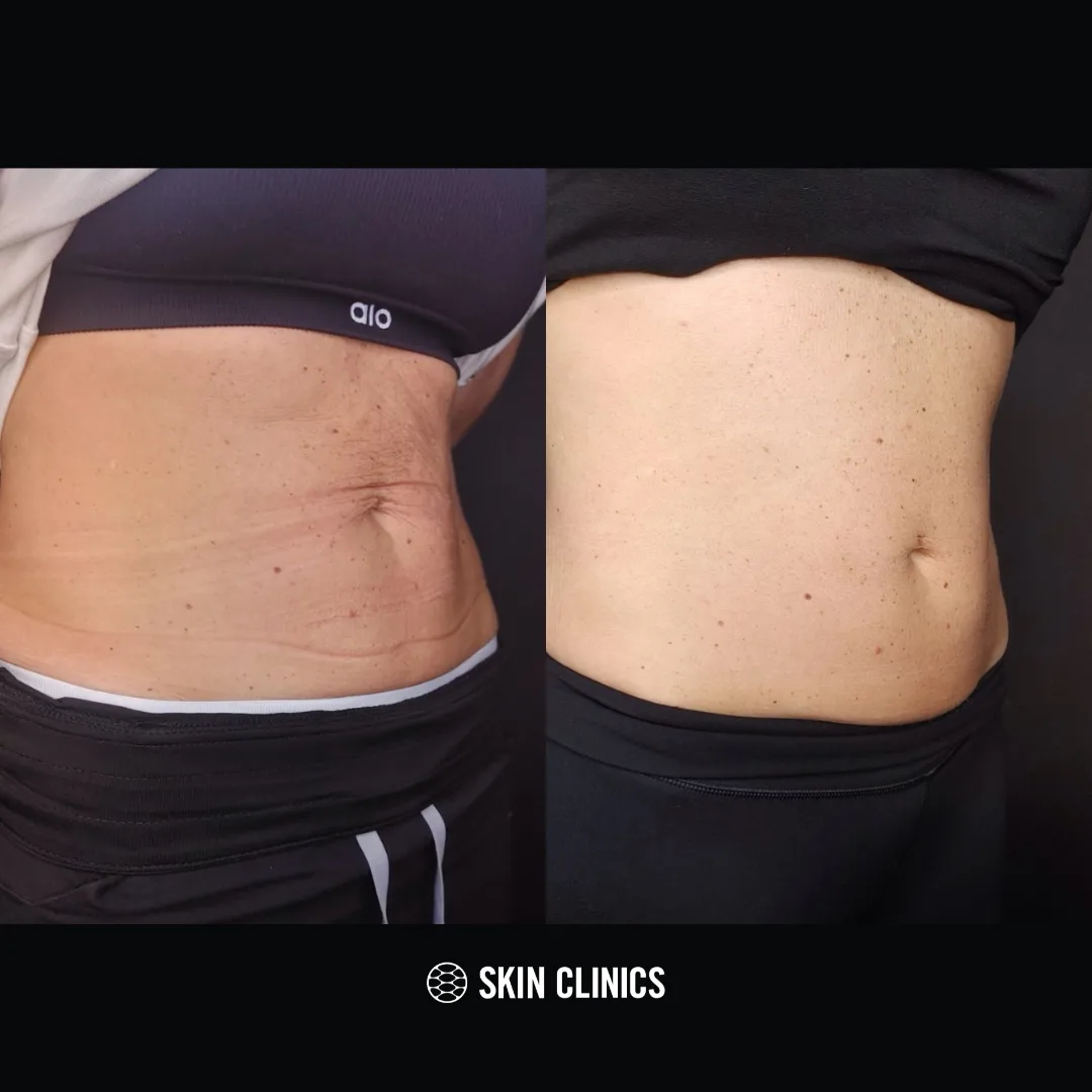 Body Skin Tightening on the Abdomen