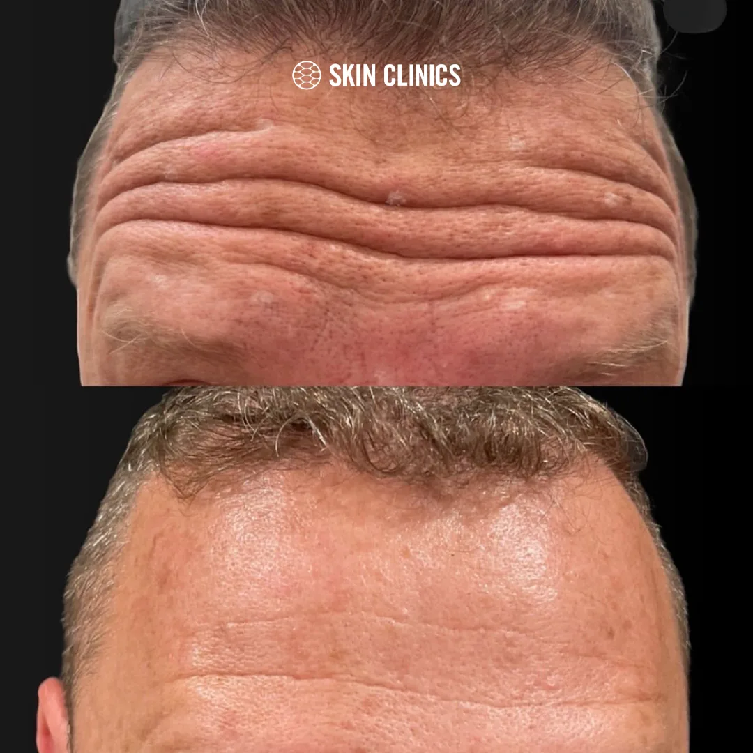 Neuromodulator Treatment: Forehead