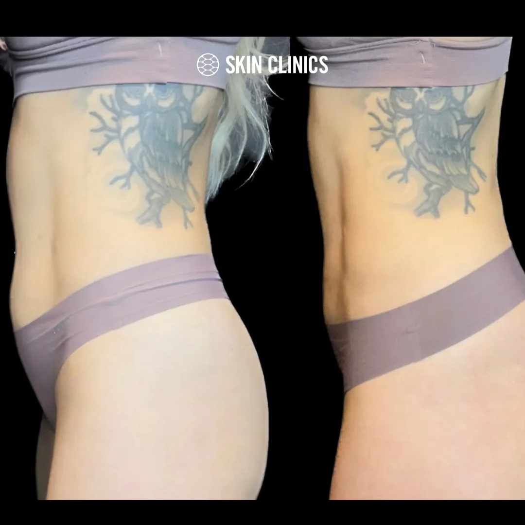 Coolsculpting treatment