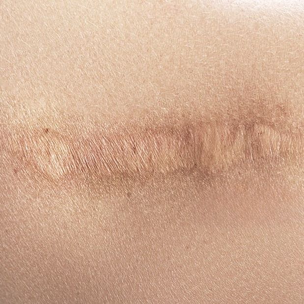 Scar Revision — treatment