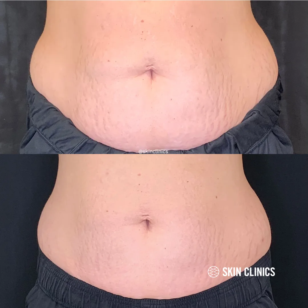 Coolsculpting treatment