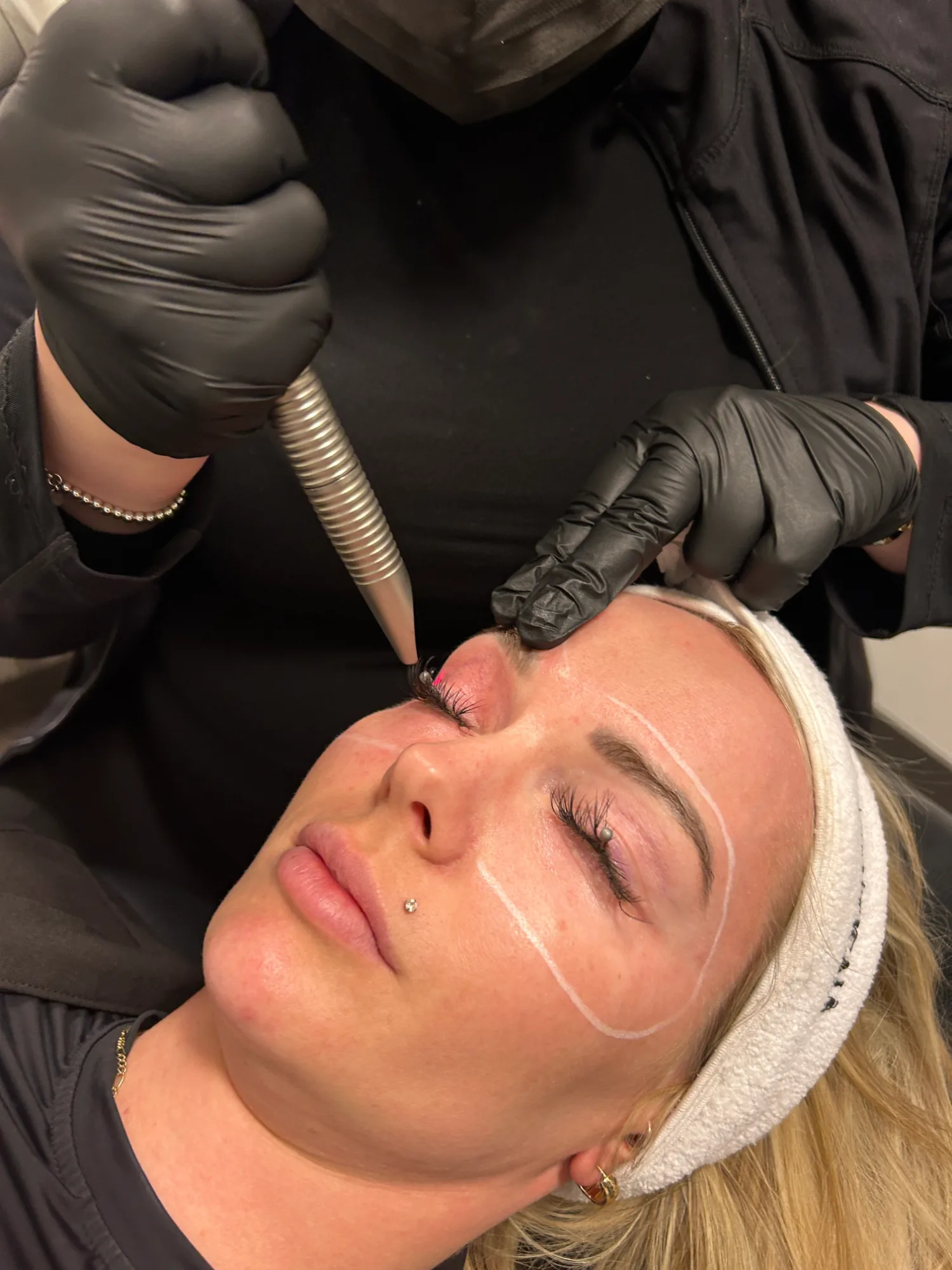 Laser Eye Resurfacing — treatment
