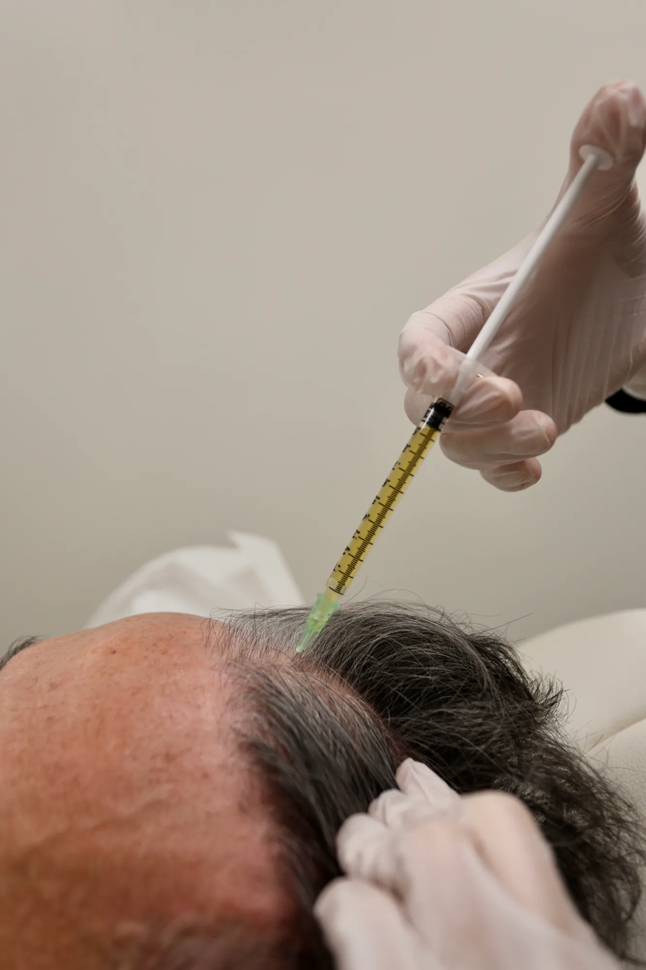 PRP Hair Treatment — treatment
