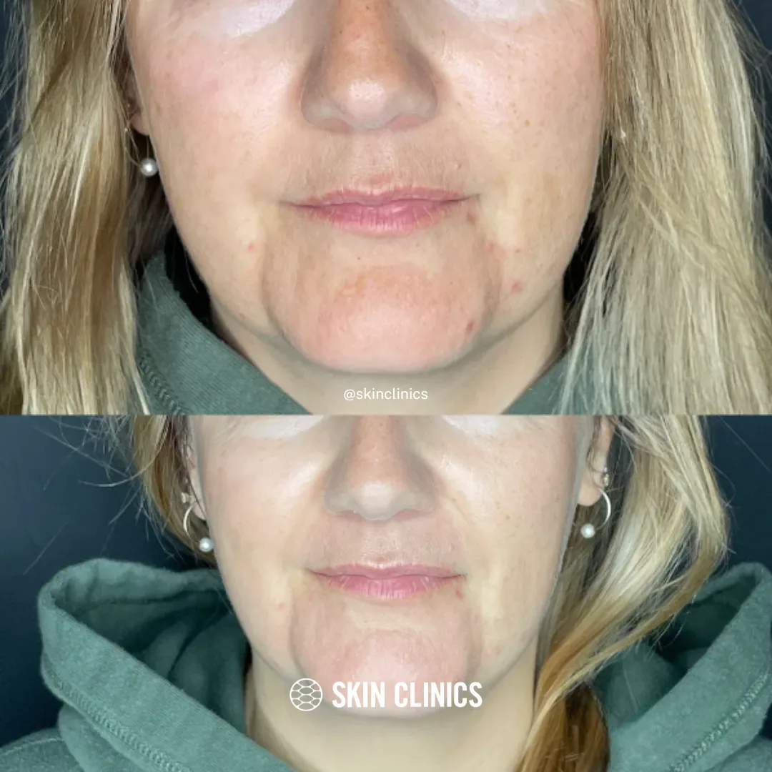 OxyGeneo Facial