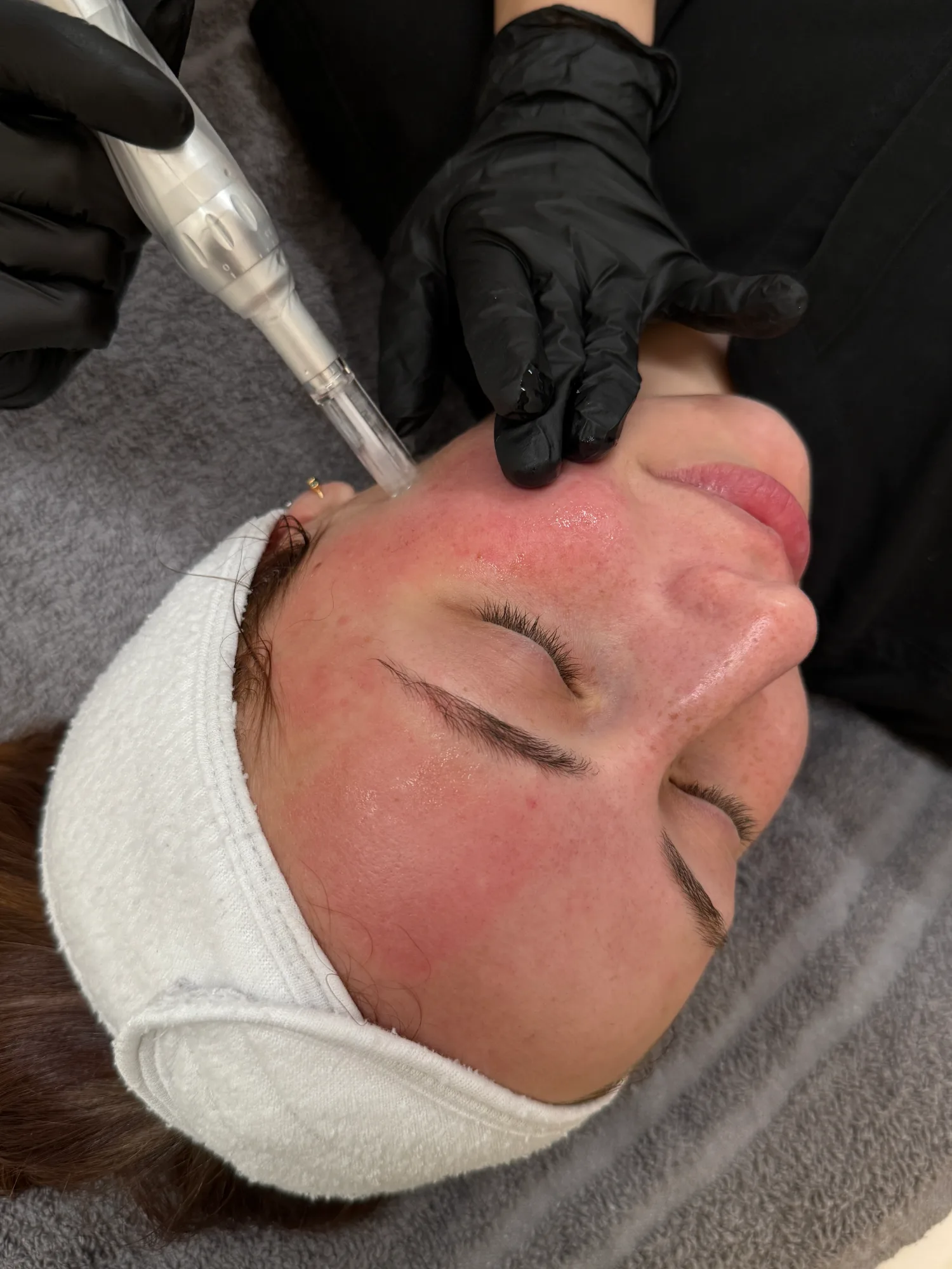 Face — in clinic