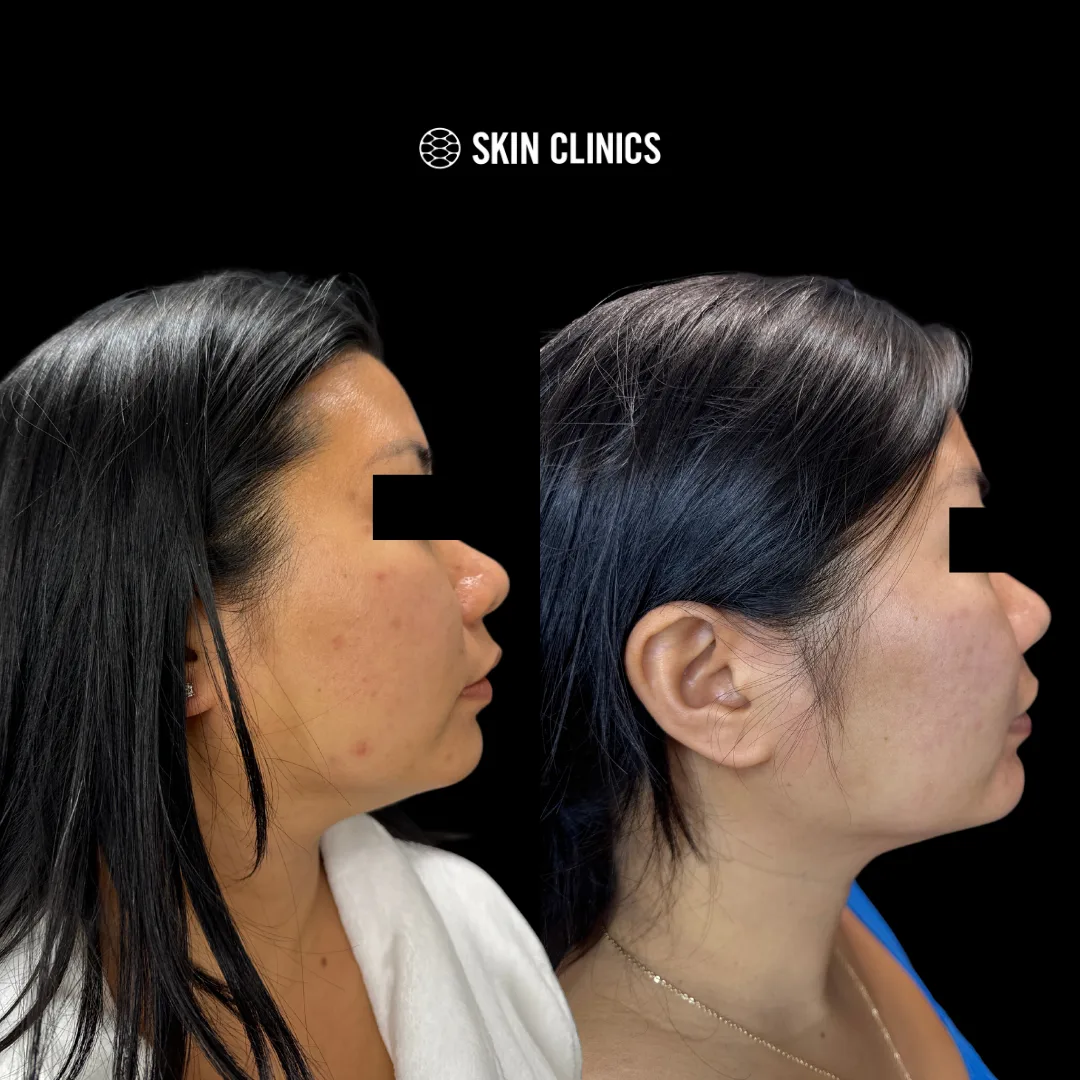 Laser Acne Treatment