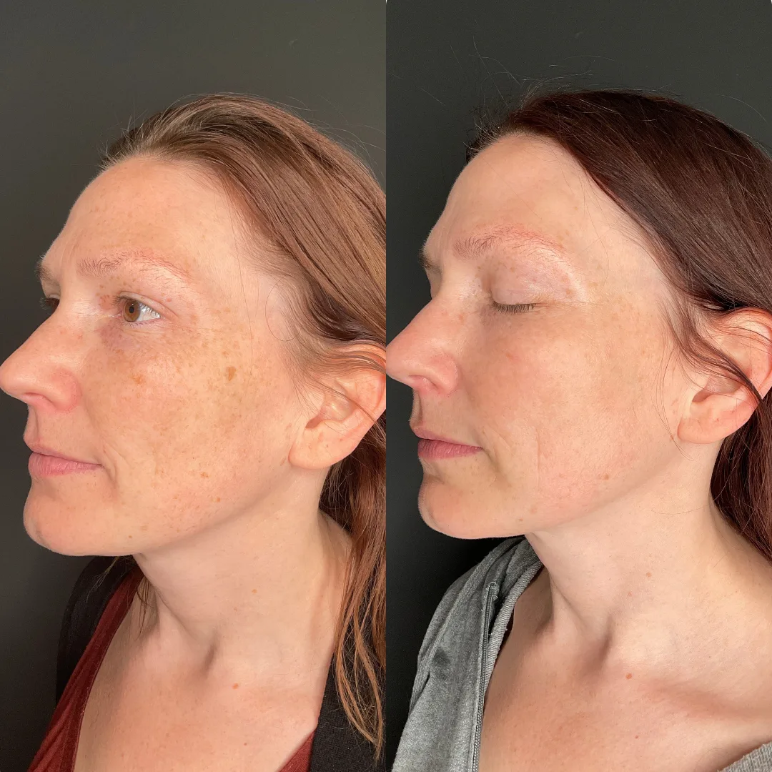 IPL treatment on the face