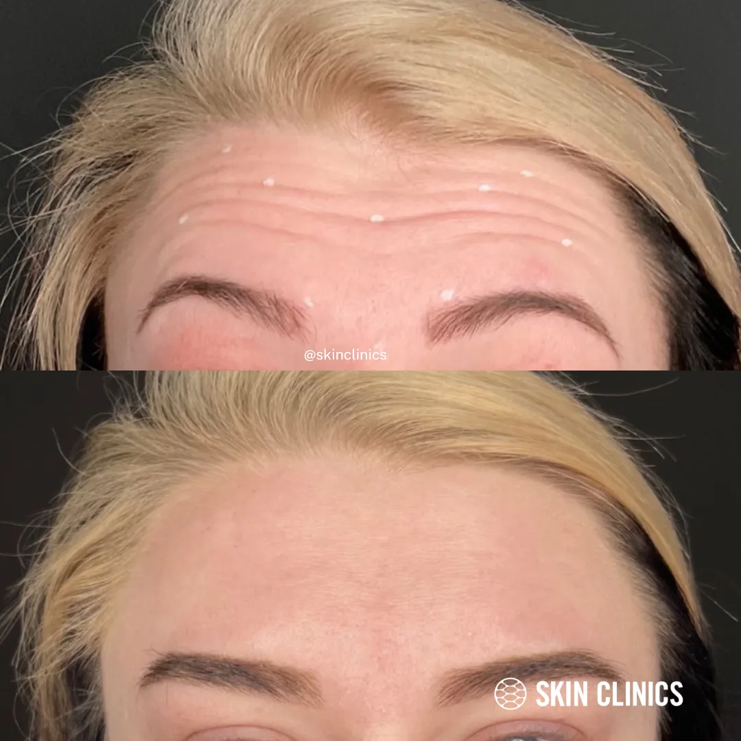 Neuromodulator Treatment: Forehead and Elevens