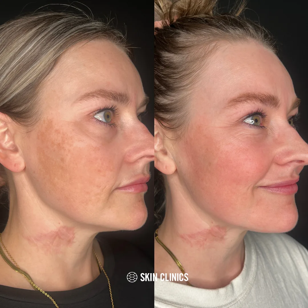 Laser Melasma Treatment