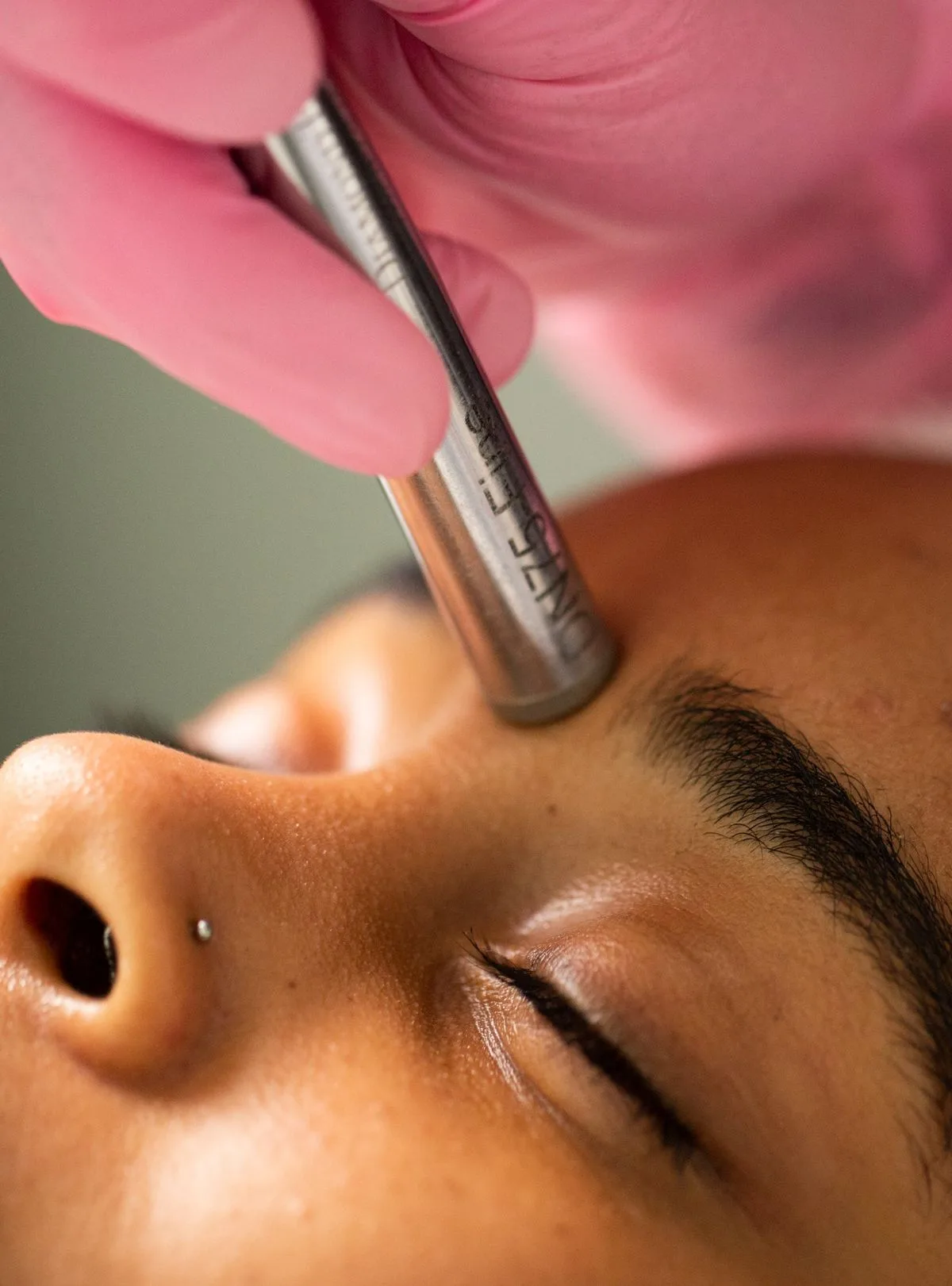 Diamond Microdermabrasion — treatment