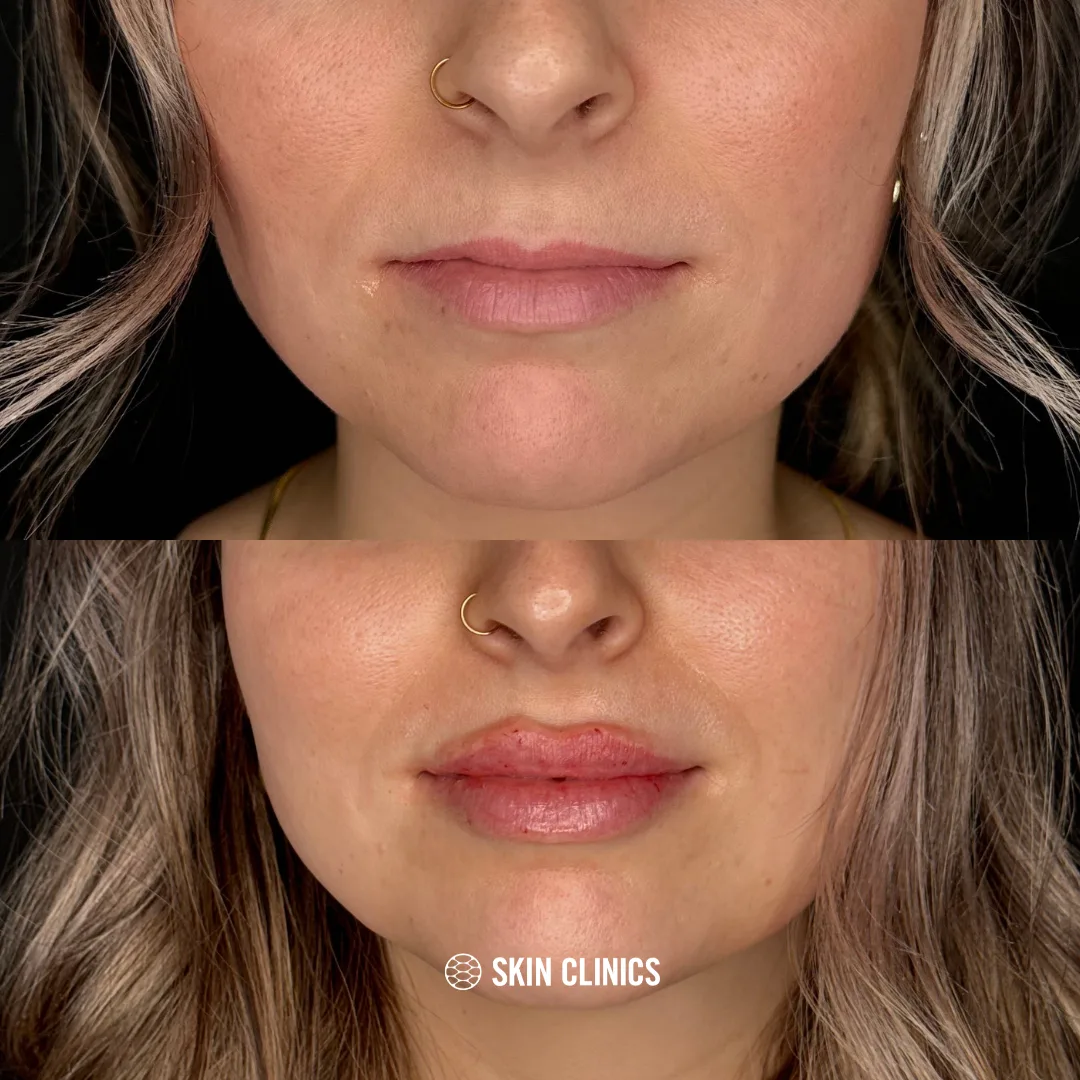 Lip Filler
