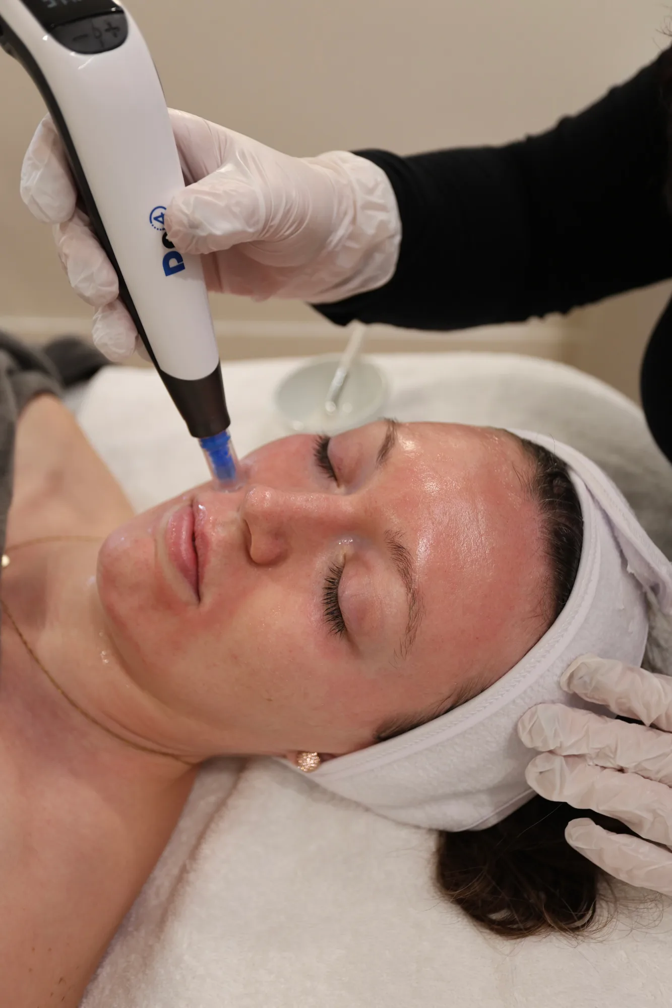 Microneedling — treatment