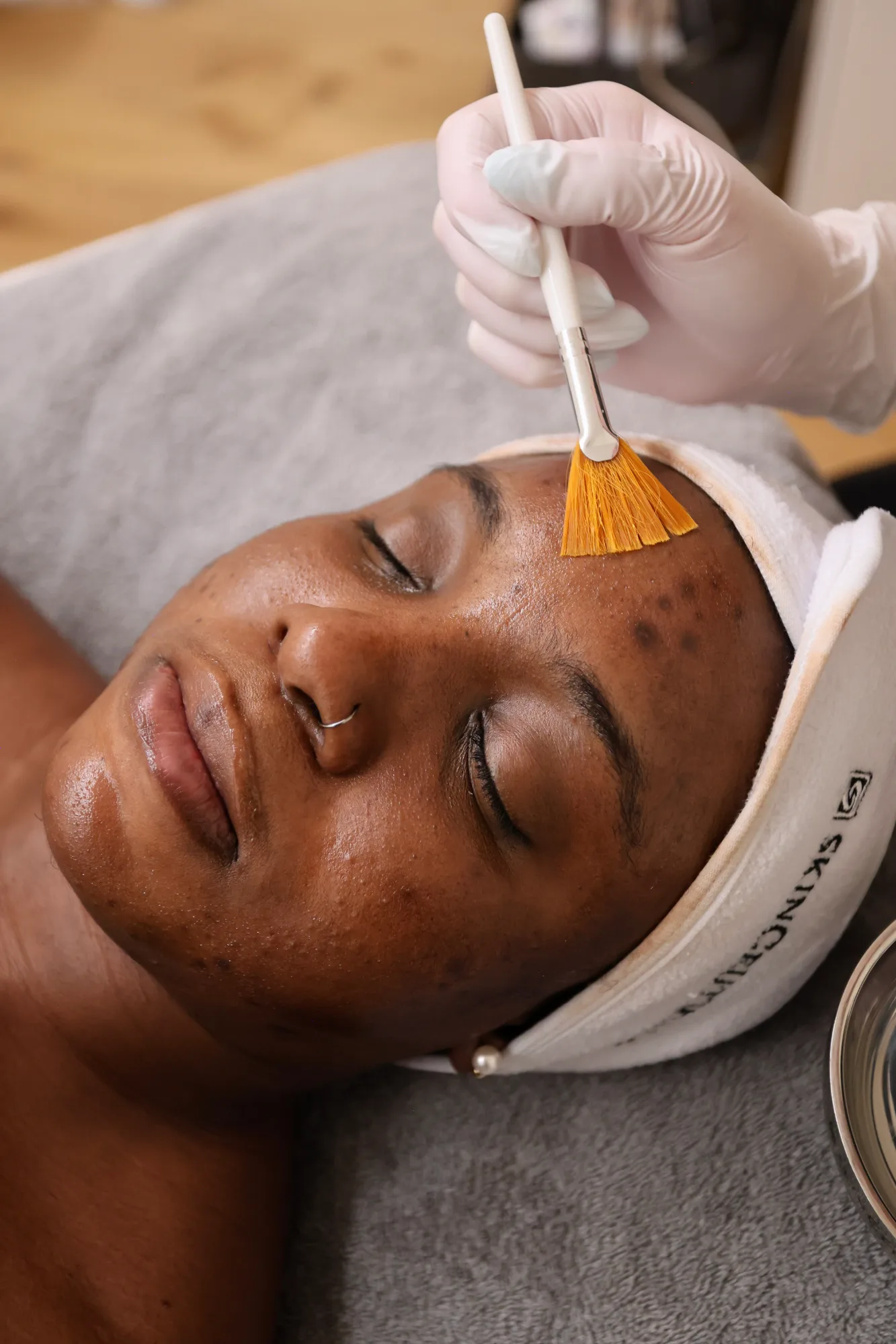 Jessner Peel — treatment