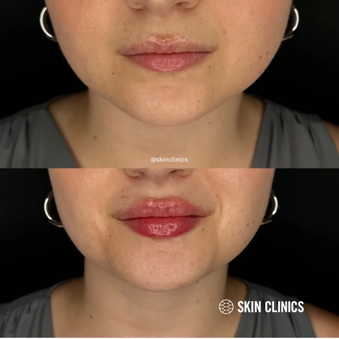 Lip Filler