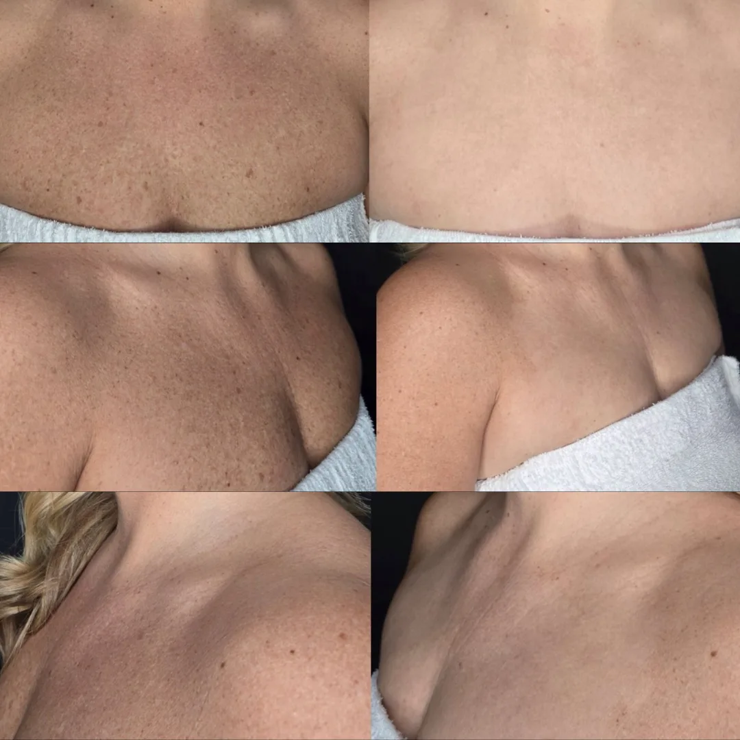 IPL décolletage treatment